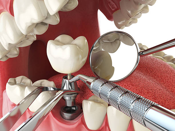Best Emergency Root Canal Treatment in Chamberlayne, VA